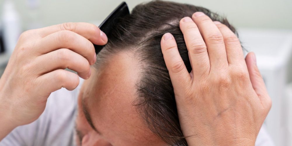 Queda de cabelo: causas comuns e como identificar