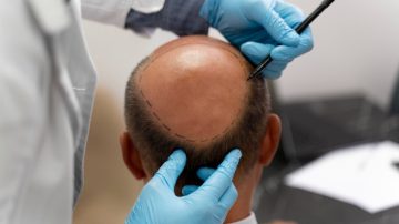 FUE ou FUT: qual a melhor técnica de transplante?