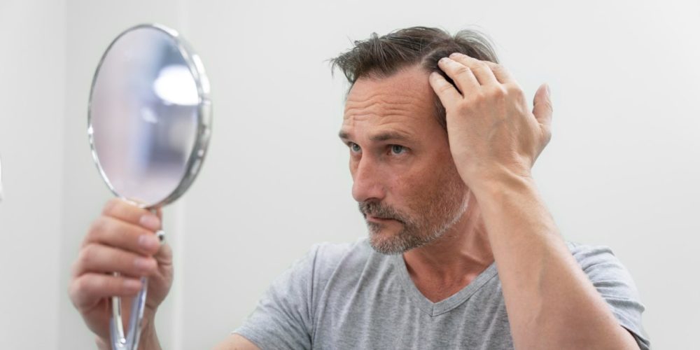 Queda de cabelo ou calvície? Veja como diferenciar