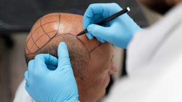 Transplante capilar dói? Saiba como é a experiência