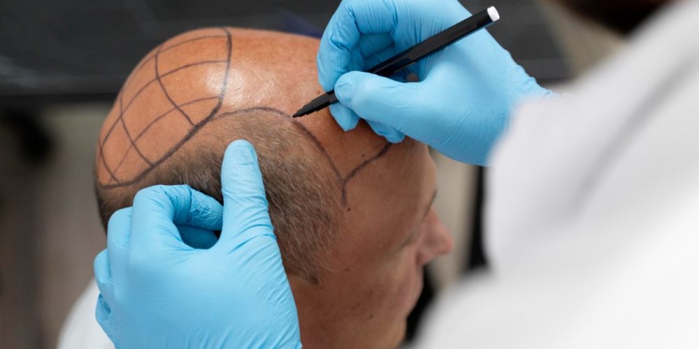 Transplante capilar dói? Saiba como é a experiência