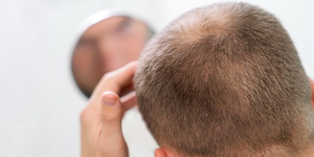 Estresse pode causar queda de cabelo? Descubra
